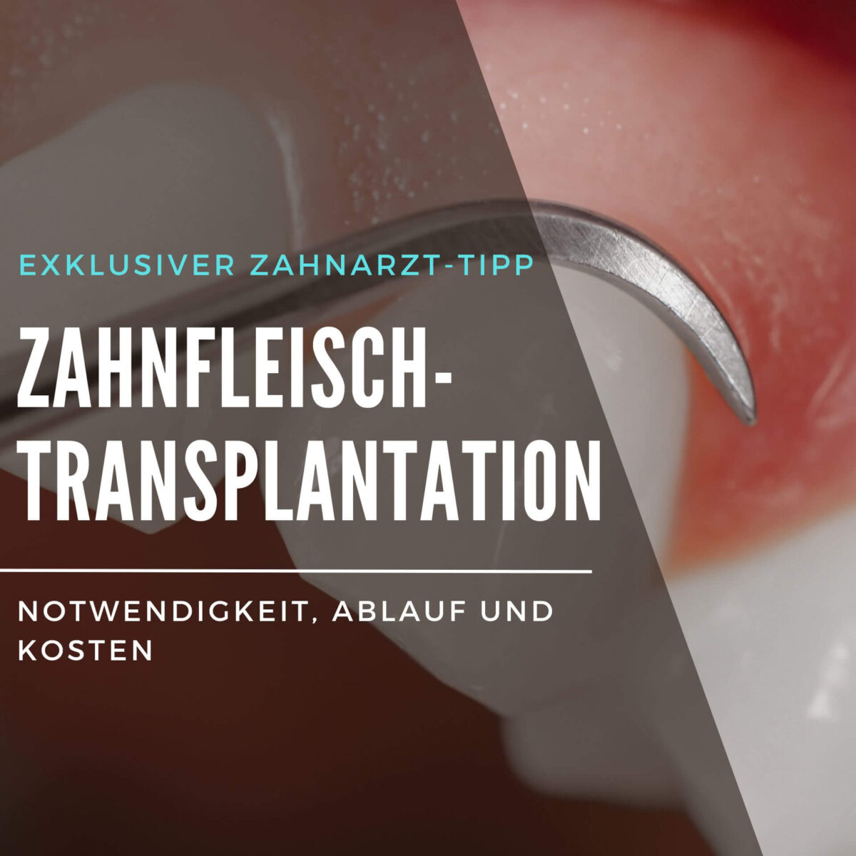 Zahn schmerzt beim Draufbeißen Ursachen und Lösungen