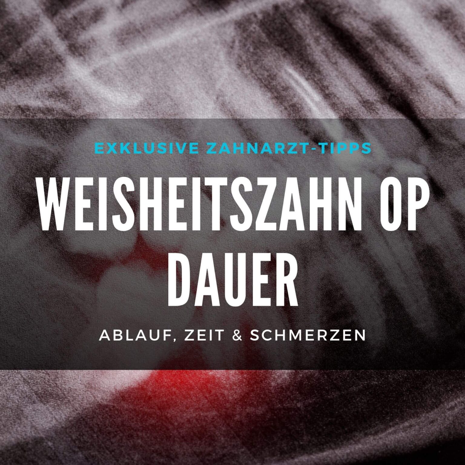 Wie lange dauert eine Weisheitszahn OP? Ablauf & Zeit