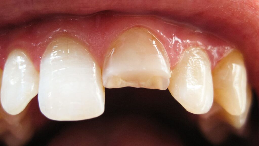 ᐅ Schneidezahn abgebrochen Was Sie tun sollten